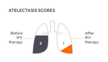 AtelectasisScores4-Chart