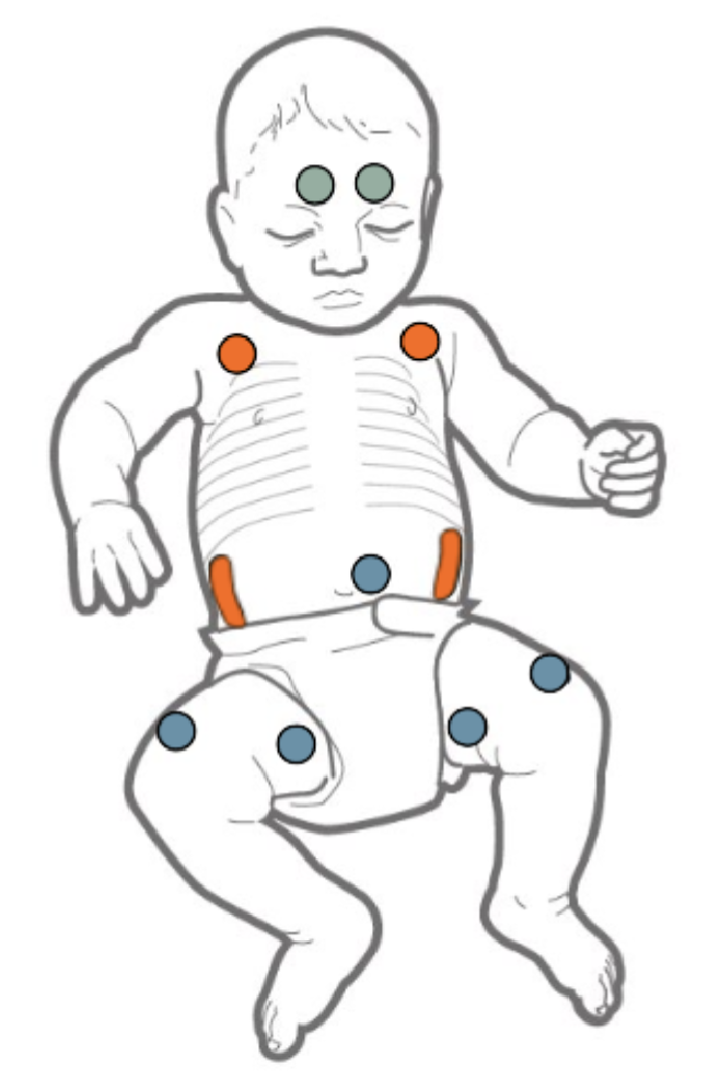 AttachmentSitesNICU